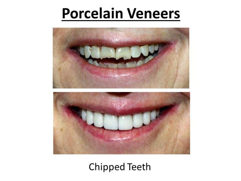 porcelain veneers for chipped teeth