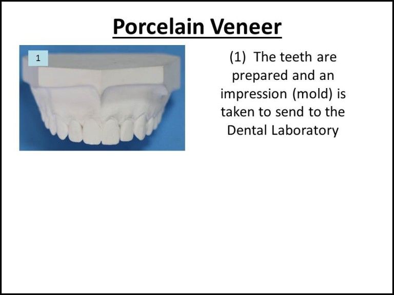 diagram of how porcelain veneers are made