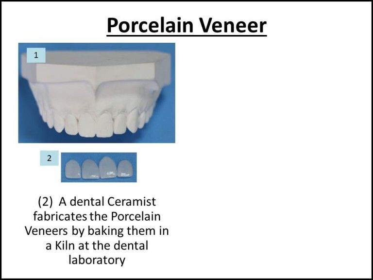 how ceramists make porcelain veneers