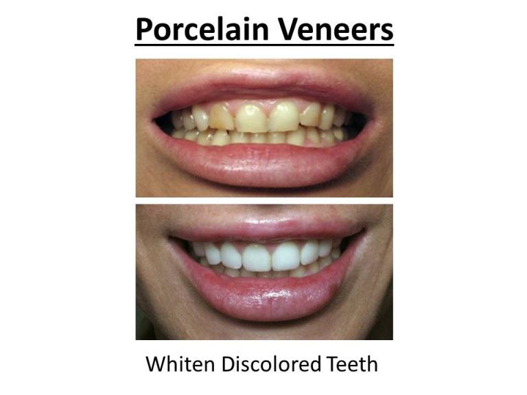 porcelain veneers for discoloration