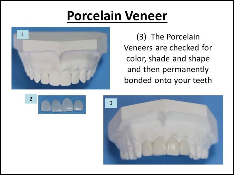 porcelain veneers