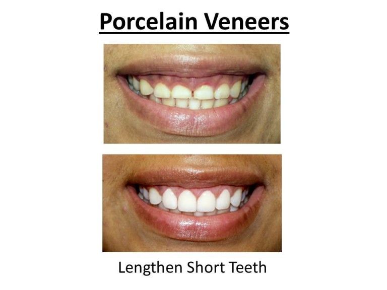 lengthen short teeth