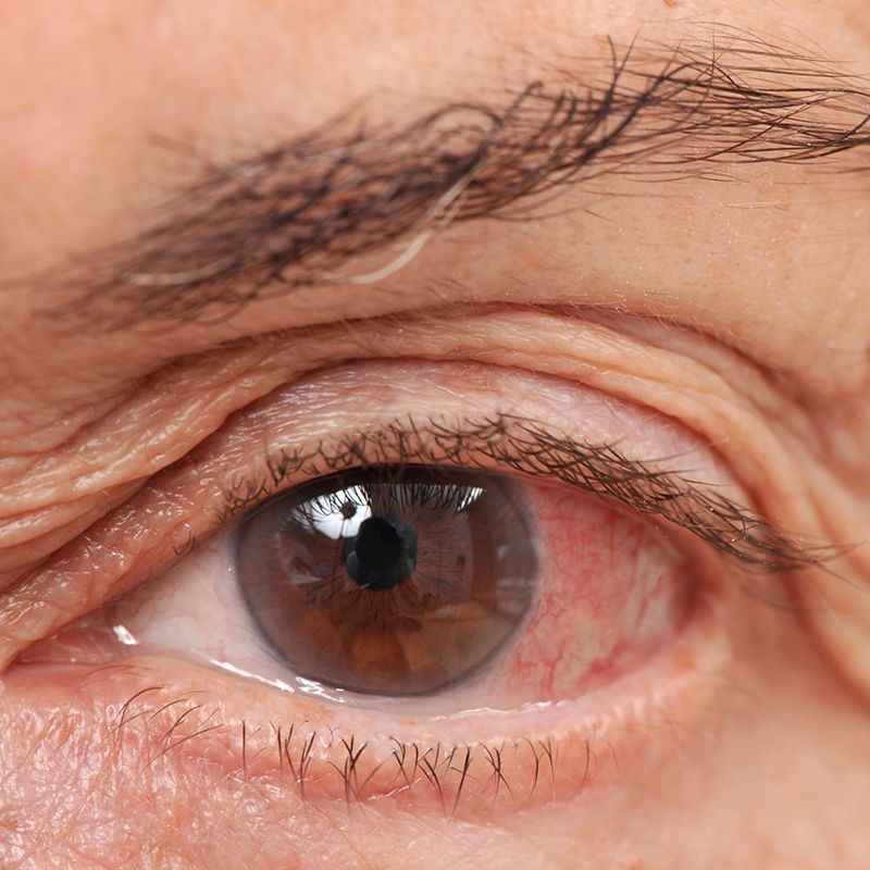 close up of an eye emergency eye care