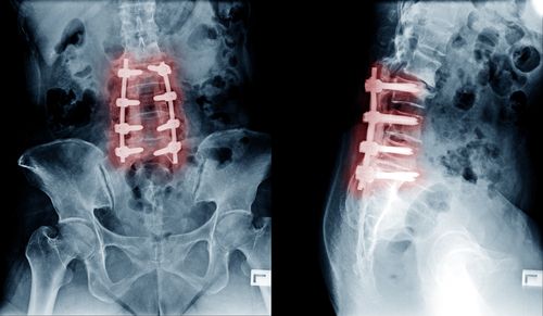 Herniated Discs: Myths vs. Facts – What You Need to Know