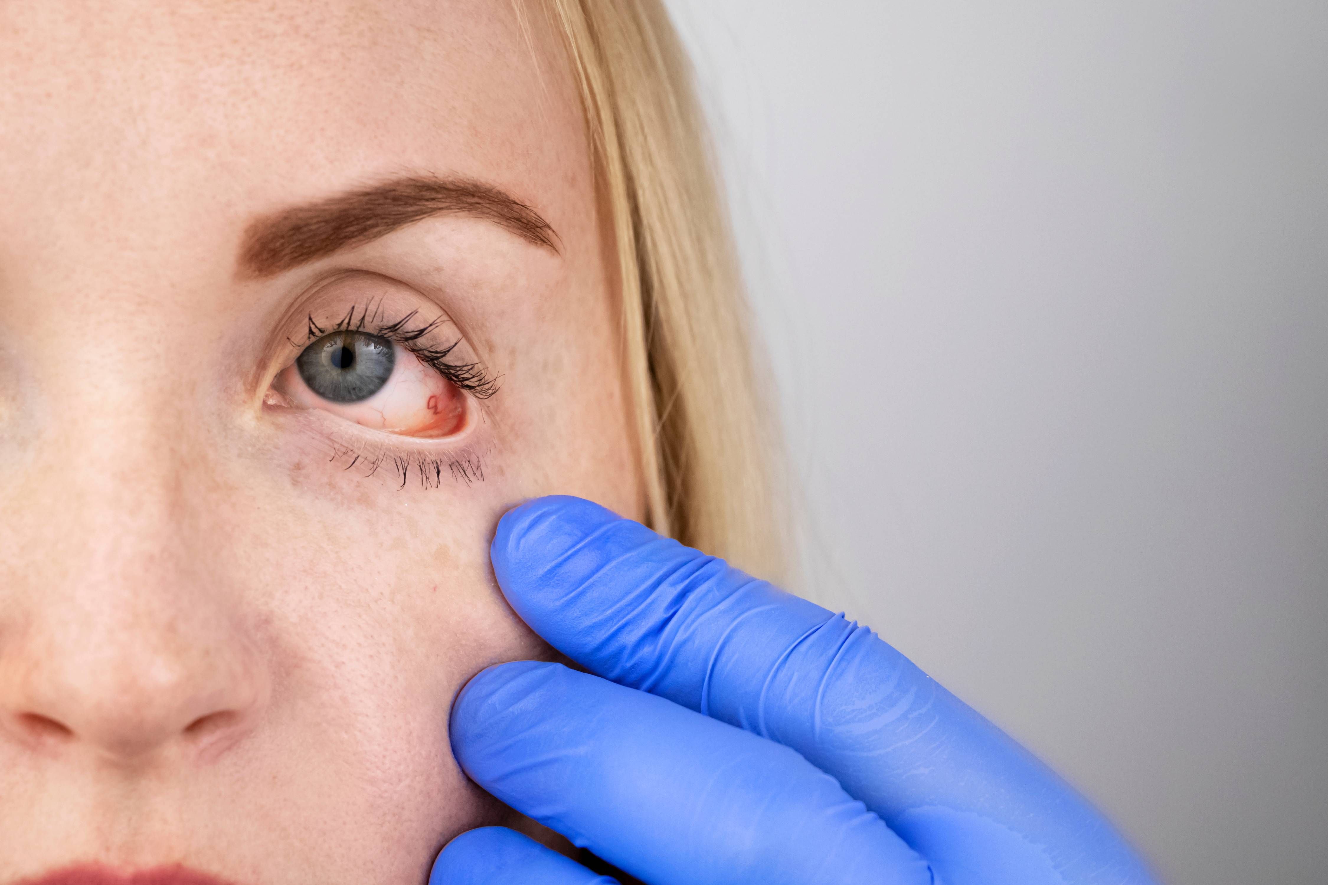 Treating Eye Infections