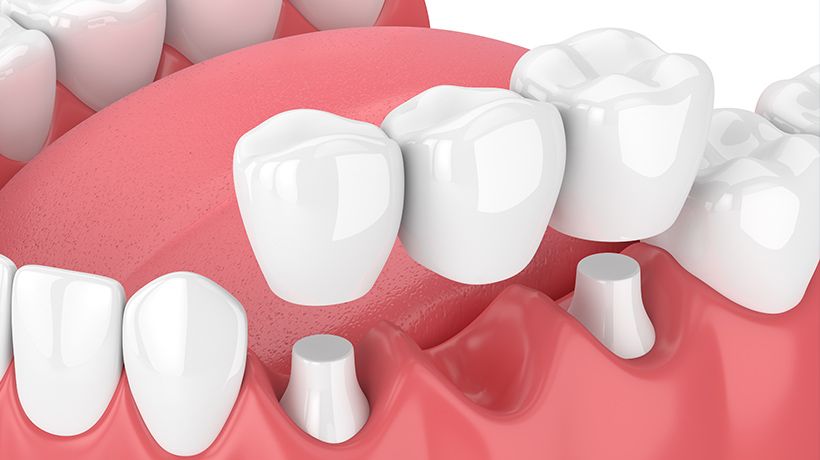 Dental Bridges