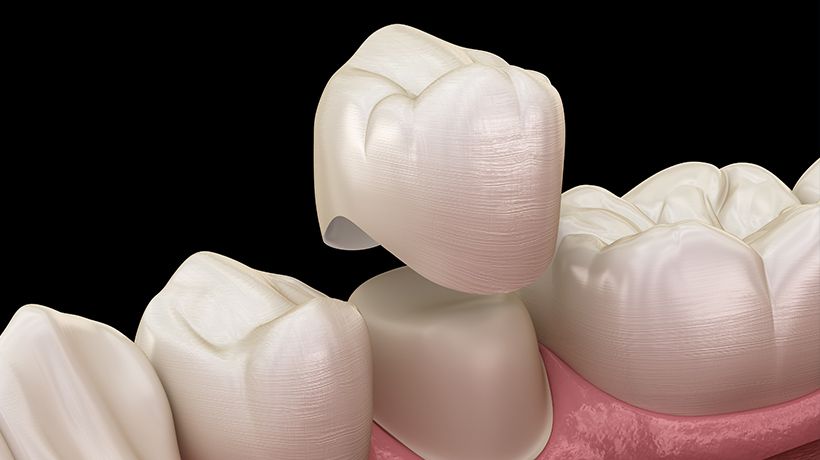 Dental Crowns