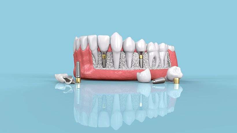 Dental Implants