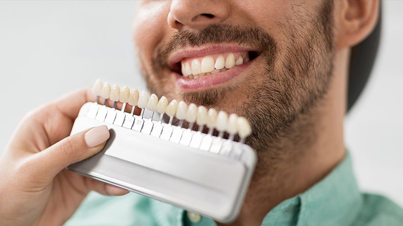 Porcelain Veneers