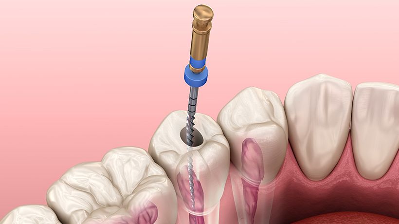 Root Canal