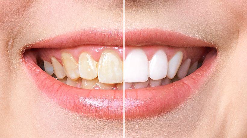 Teeth Whitening