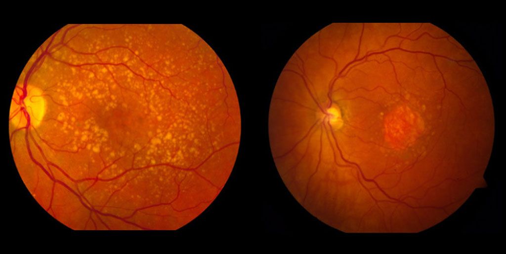 Macular Degeneration