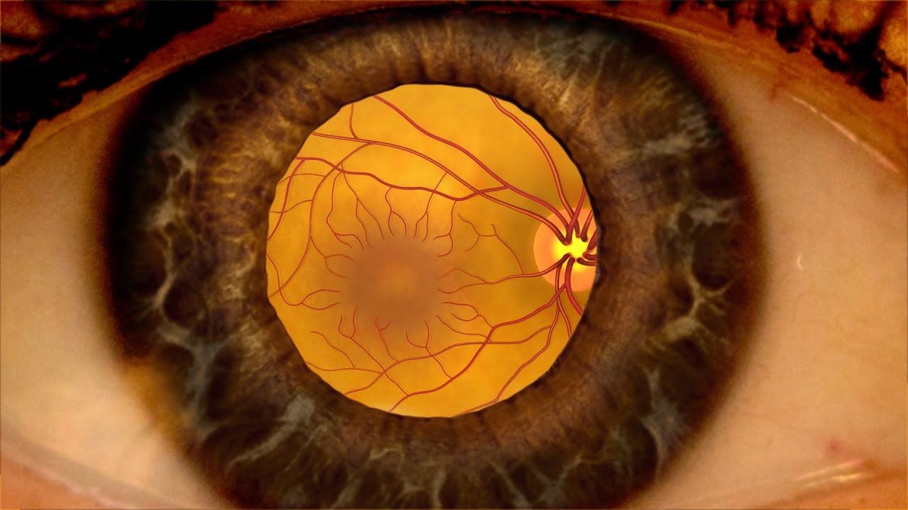 Diabetes Retinophaty