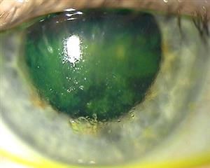 Keratitis