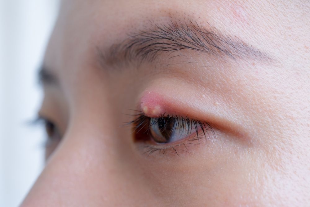 How Is a Chalazion Treated?