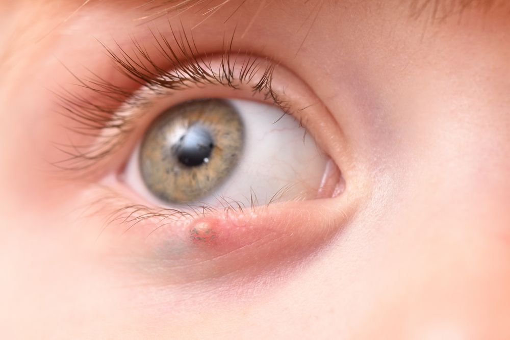 What Is a Chalazion?