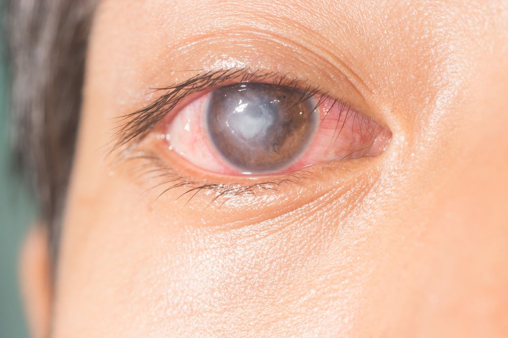 Treating Neurotrophic Keratitis