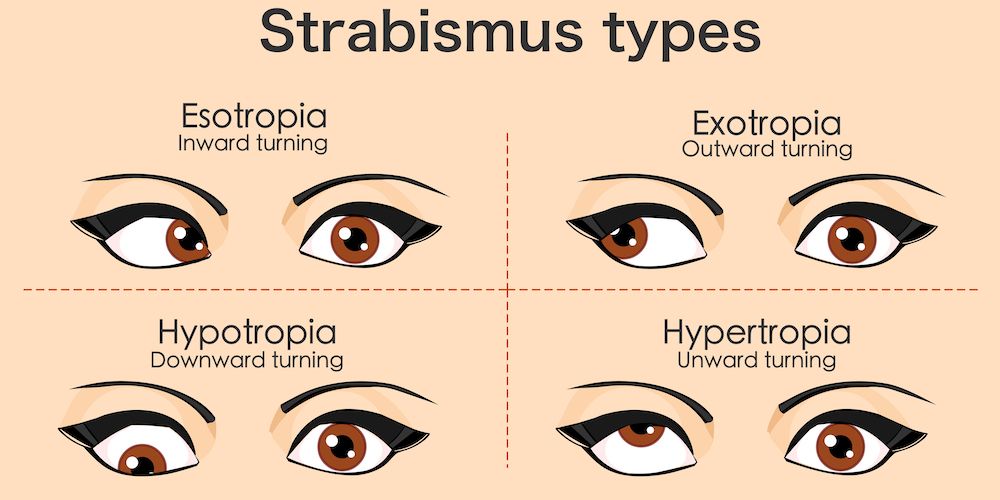 Common Signs of Eye Misalignment