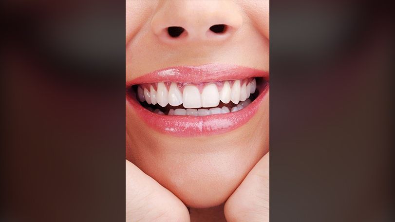 Smile makeover transformation