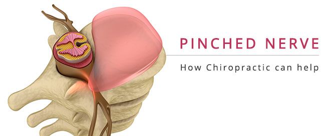 Can A Chiropractor Treat Pinched Nerves?