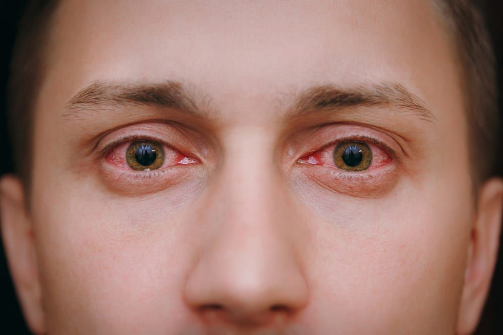 Quick Solutions For Alleviating Red Eyes From Cannabis Use