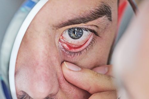 What’s the Role of Meibomian Gland Dysfunction in Dry Eye?