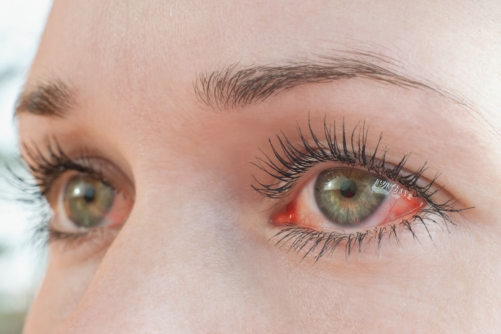 Symptoms of Dry Eye vs. Seasonal Allergies