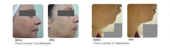Before and after Juvashape