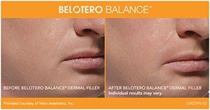 Before an after belotero