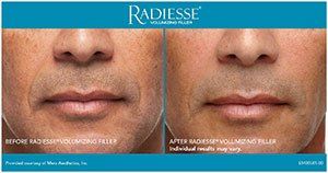 Before and after Radiesse