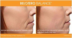 Before an after belotero