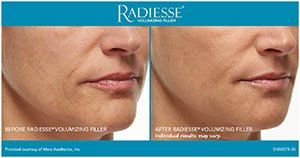 Before and after Radiesse