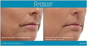 Before and after Radiesse