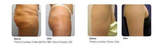 Before and after Juvashape
