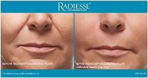 Before and after Radiesse