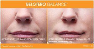 Before an after belotero
