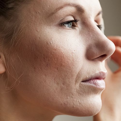 treatments for acne scaring