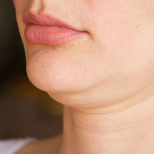 treatments for double chin