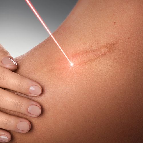 scar removal and stretch mark removal