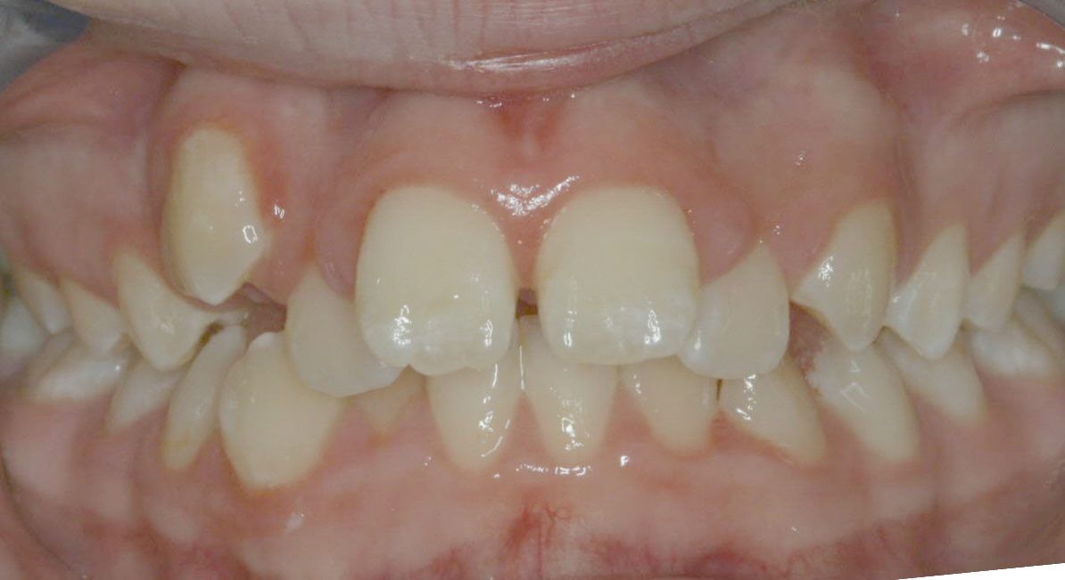 before-after-children-dentist-2