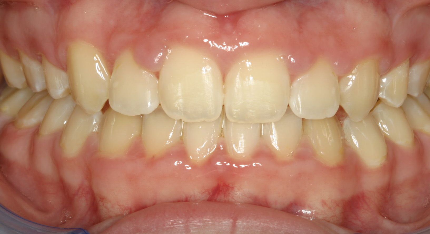 before-after-children-dentist-3