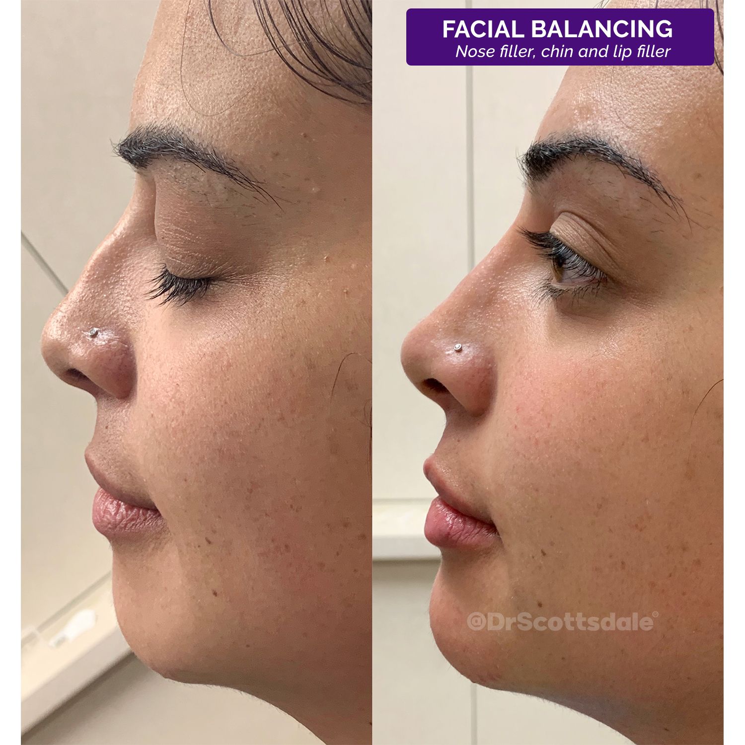 facial balancing
