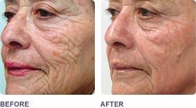 before and after fractional CO2 Lasers