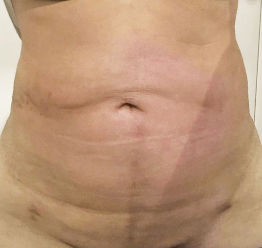 After J-Plasma