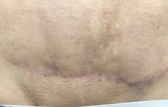 After Laser Resurficing