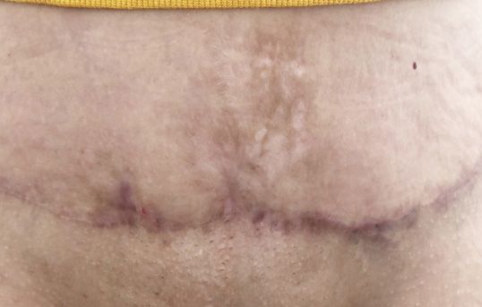 Before Laser Resurficing