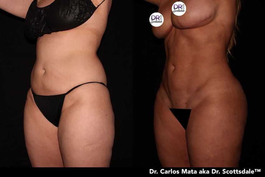 Liposuction Austin