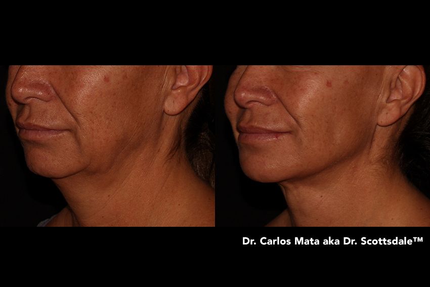 Magic Tight Nonsurgical Skin Tightening In Scottsdale Az