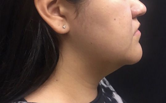 Before Trusculpt