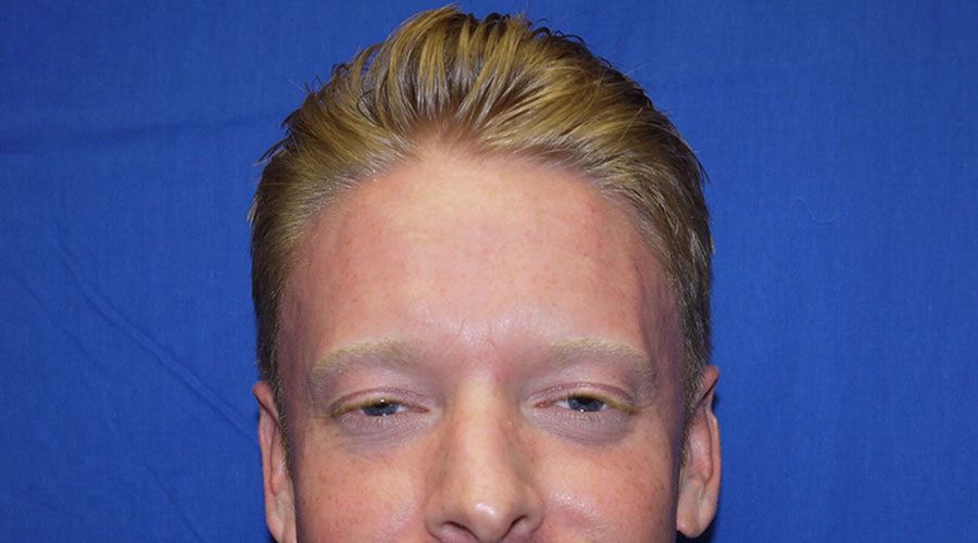 After botox